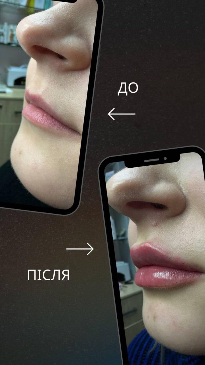 Контурна пластика губ 60 хв