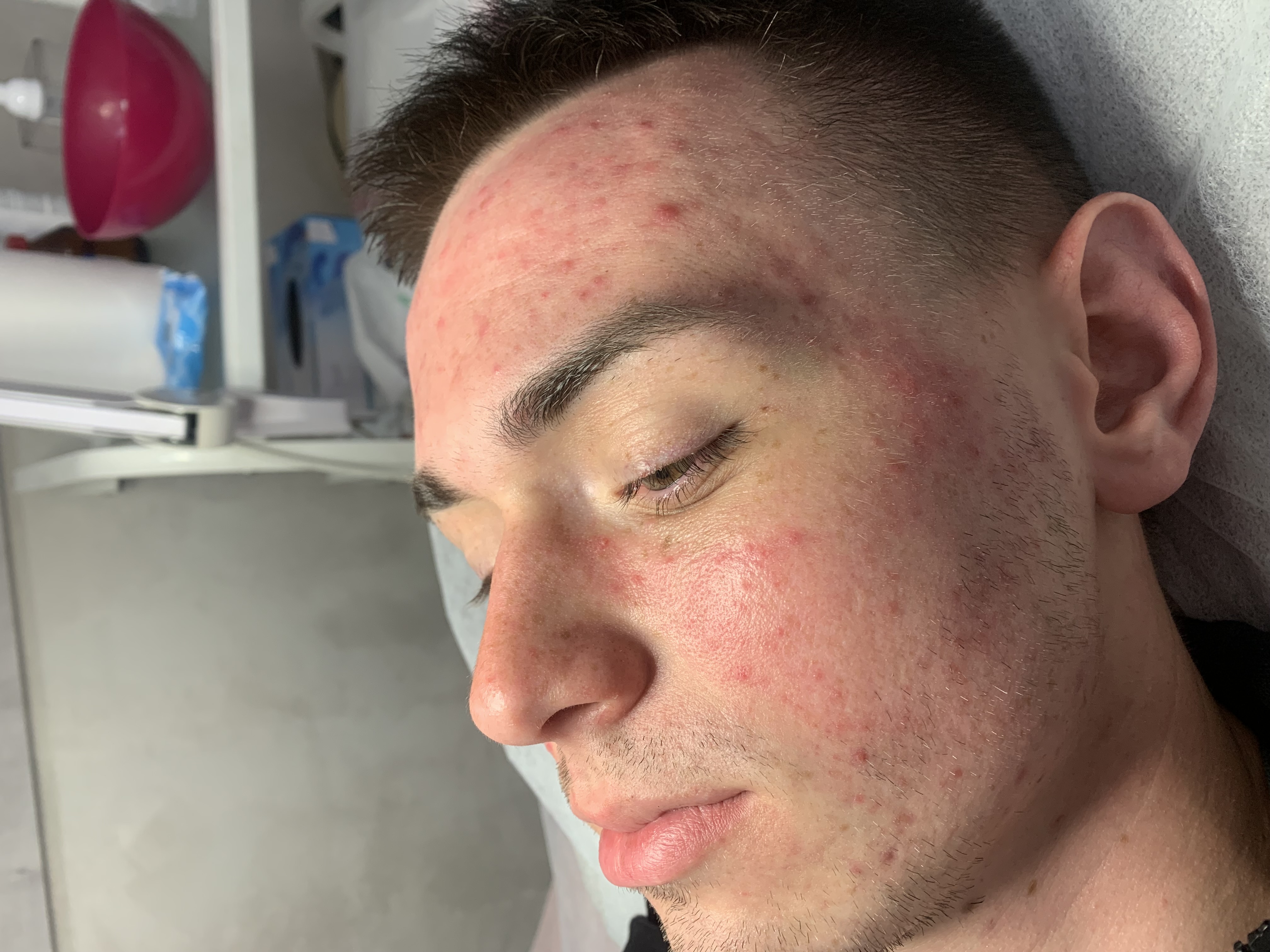 Пілінг комбінований Anubis