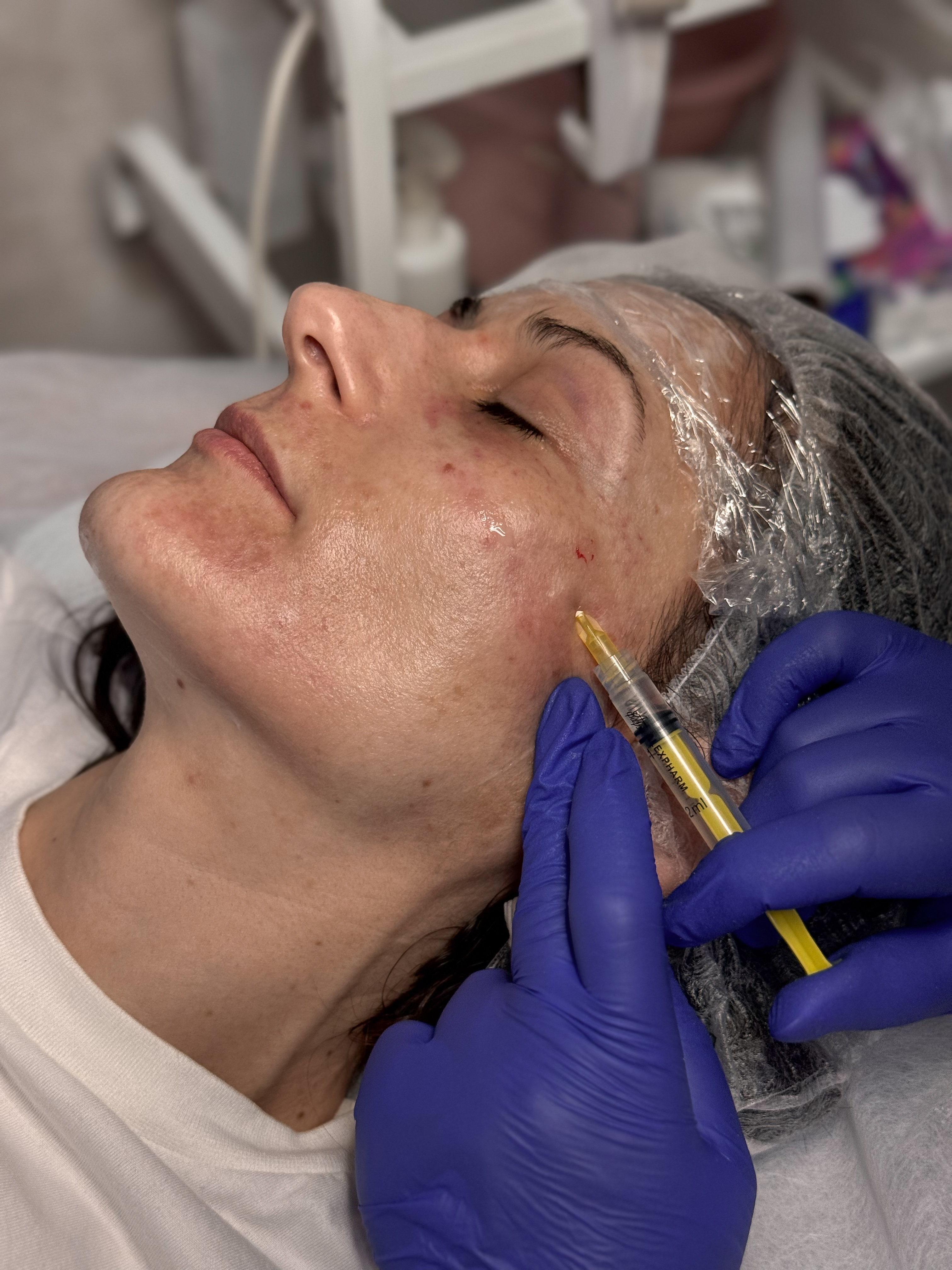 Мезотерапія (30-40 хв)