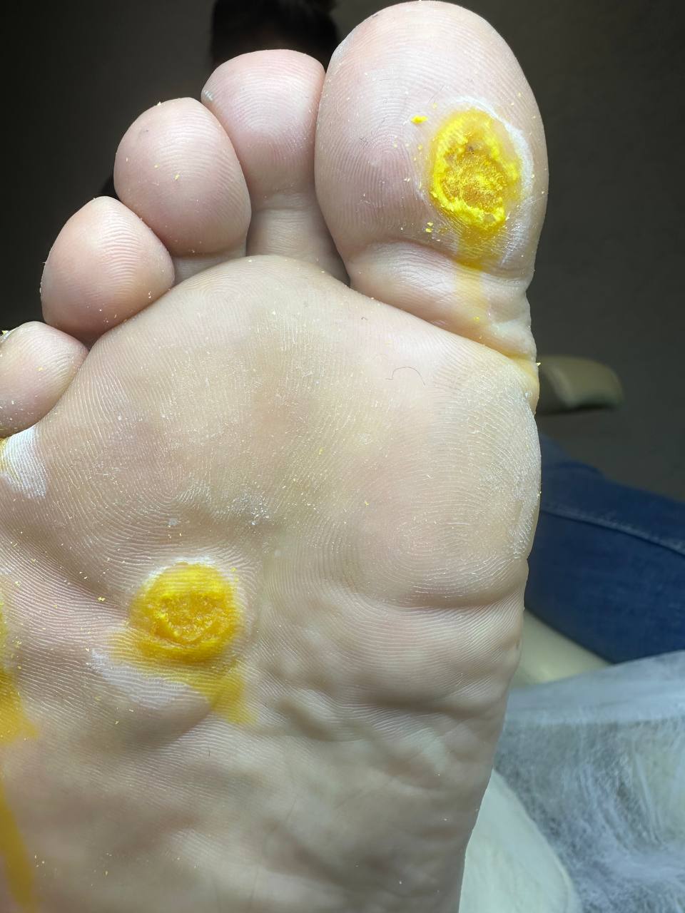 Видалення бородавок 1-3 шт